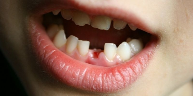 Nằm Mơ Thấy Rụng Răng Hàm Dưới - Thông Điệp Đổi Vận